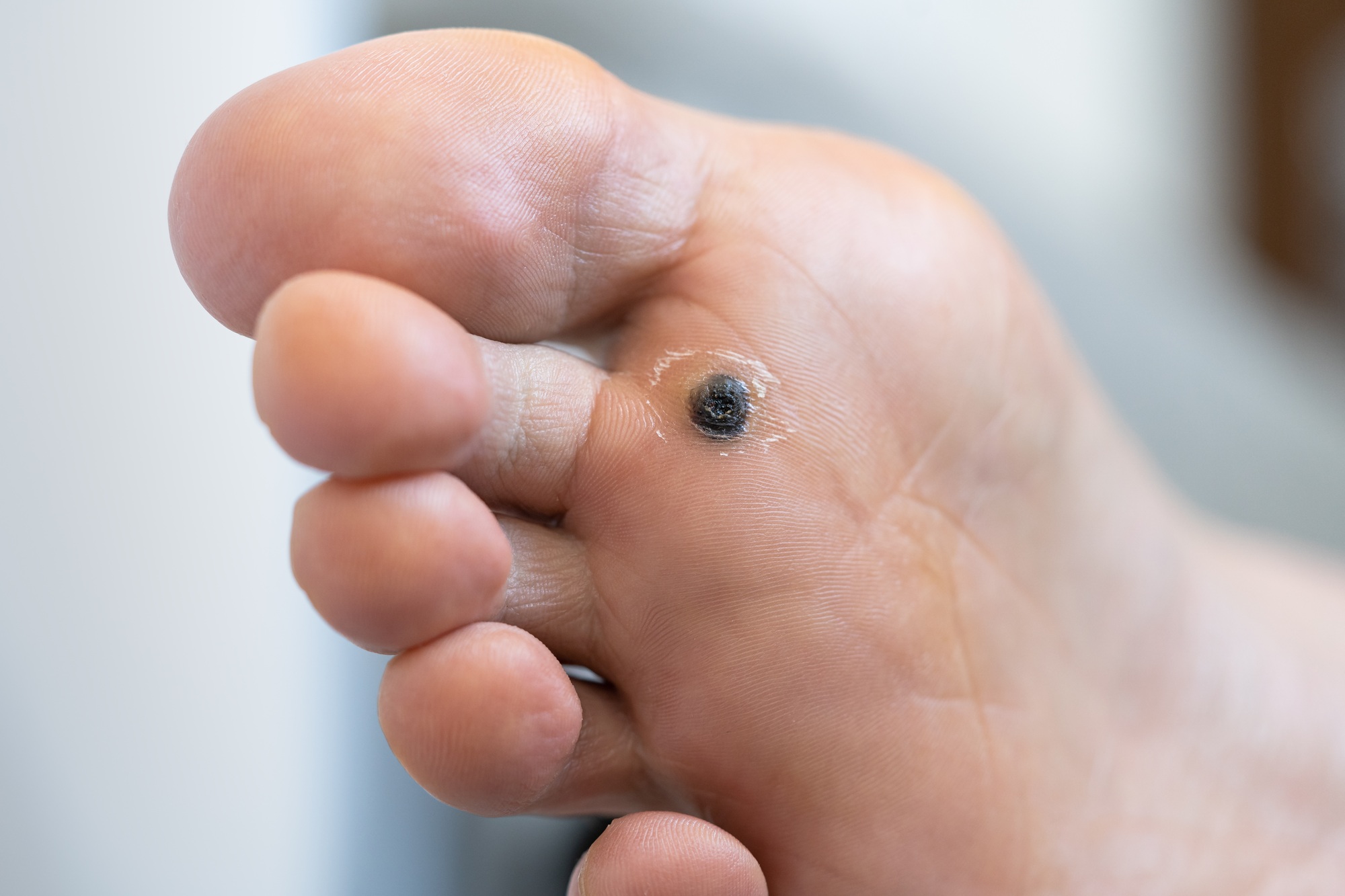 Closeup of wart plantar after cauterizing it with celandine on infected foot. Papillomavirus or HPV