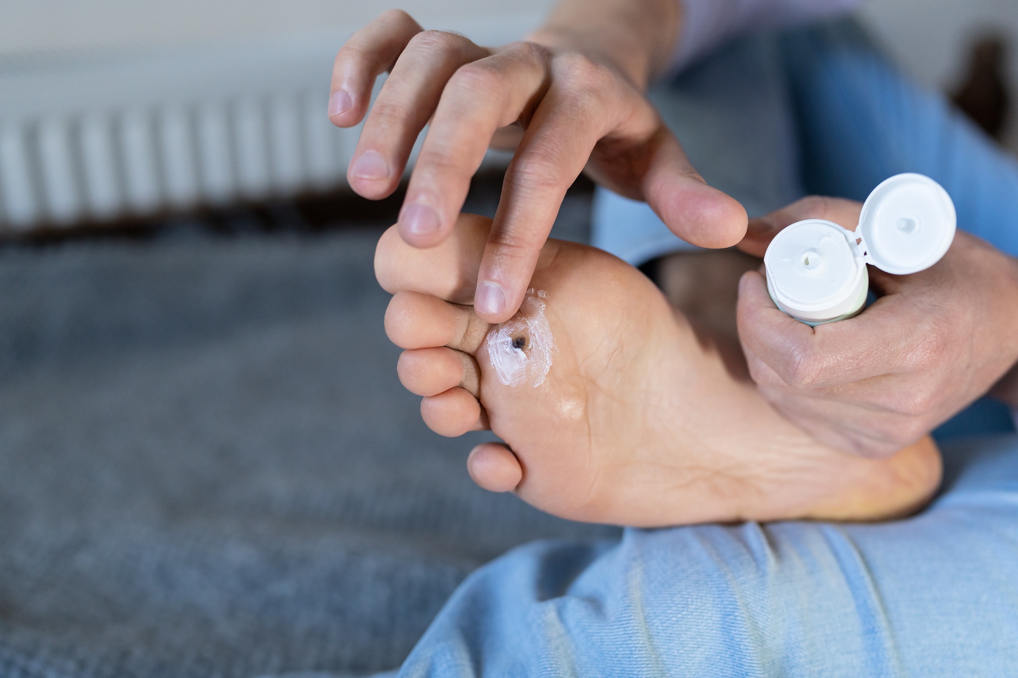Éviter les infections avec les verrues plantaires qui noircissent
